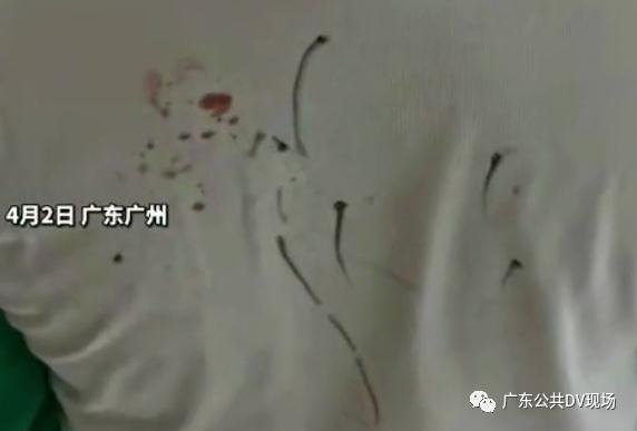 一小學(xué)生被同學(xué)用鉛筆戳20多處傷口，最新進(jìn)展來了