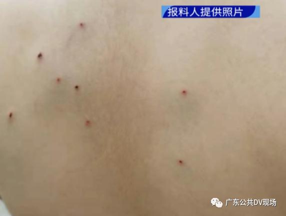 一小學(xué)生被同學(xué)用鉛筆戳20多處傷口，最新進(jìn)展來了