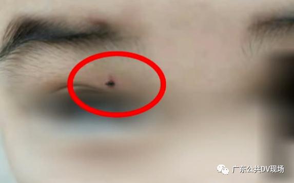 一小學(xué)生被同學(xué)用鉛筆戳20多處傷口，最新進(jìn)展來了