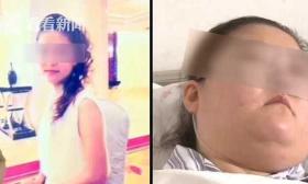 90后大学生患上罕见病容貌大变 5年内复发16次