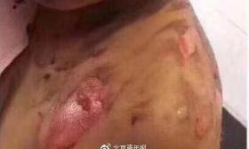 小学生倒热水烫伤同学 其母系副校长已被免职