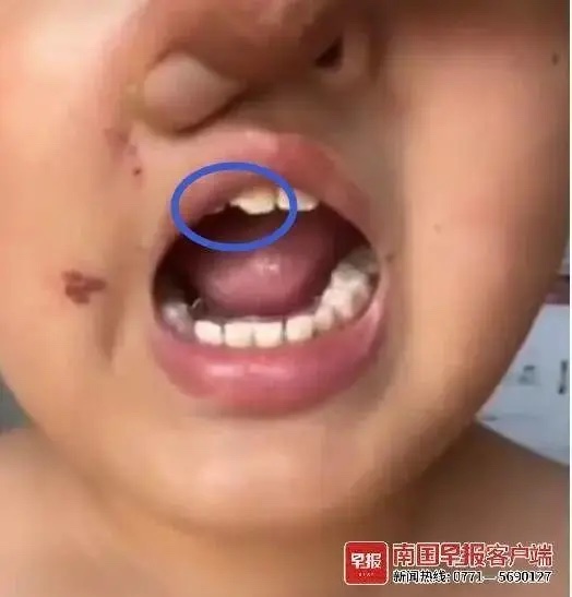 8歲孩子遭班主任毆打，被扎近20個針眼？警方介入
