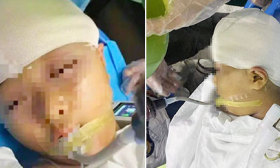 被老师打破头骨女孩已出院，父亲：计算能力下降，或患癫痫