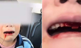 一年级女生被同学打得满嘴是血，家长不追究！教育局：不是霸凌